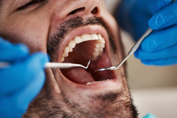 Best Knocked-Out Tooth (Avulsed Tooth) Treatment in Acushnet Center, MA